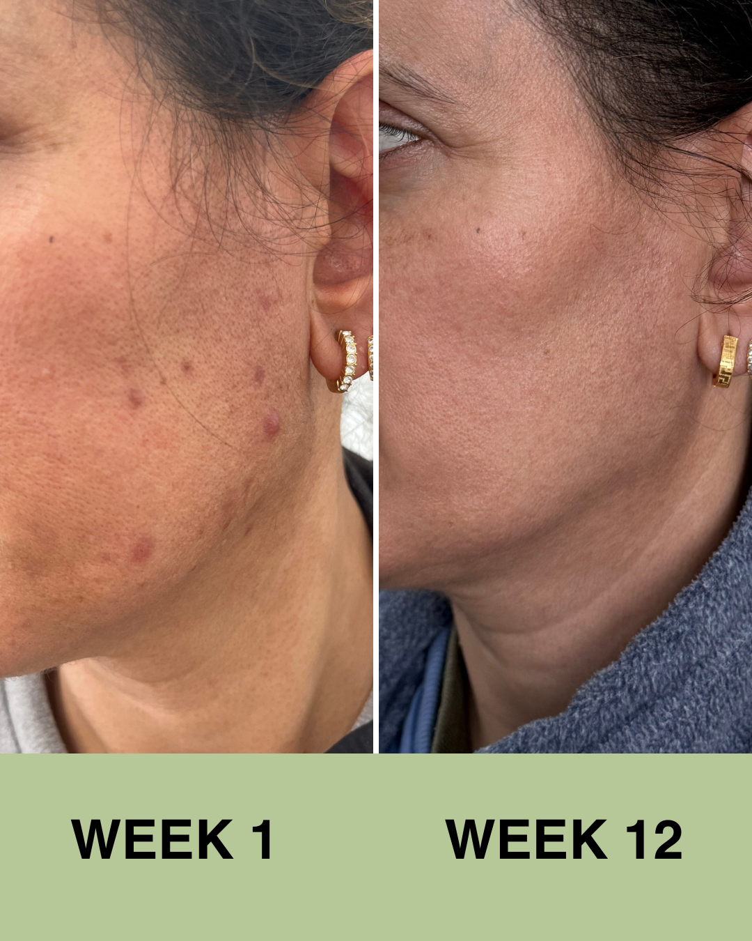 Travel Size Mini Skincare Ritual (Uneven skin tone)