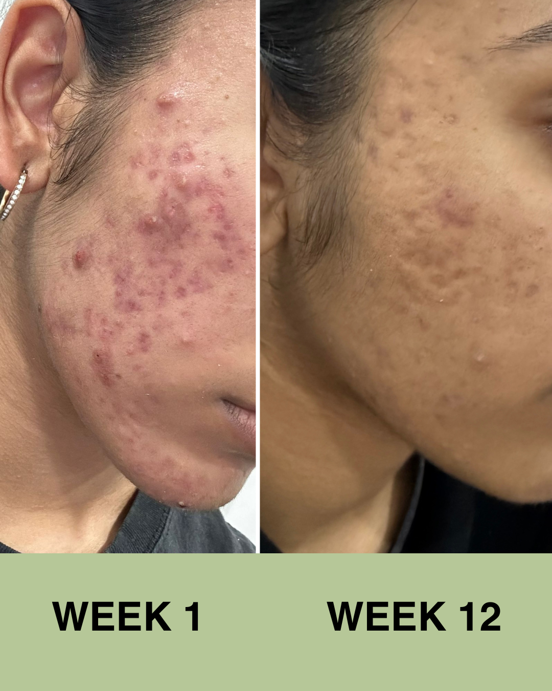 Travel Size Mini Skincare Ritual (Acne Prone)