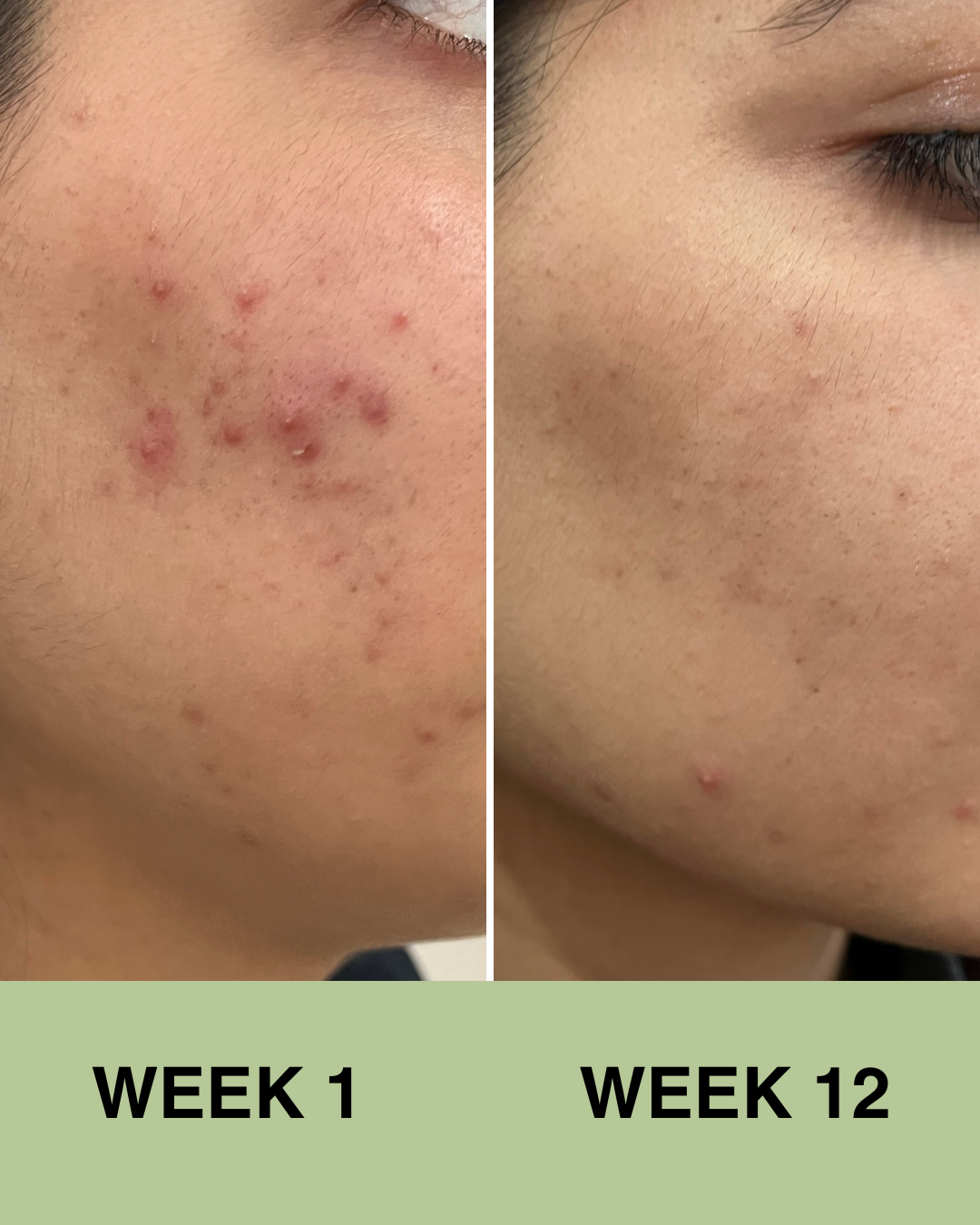 Travel Size Mini Skincare Ritual (Acne Prone)